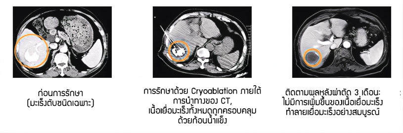 2024.05.09Cryoablation.png